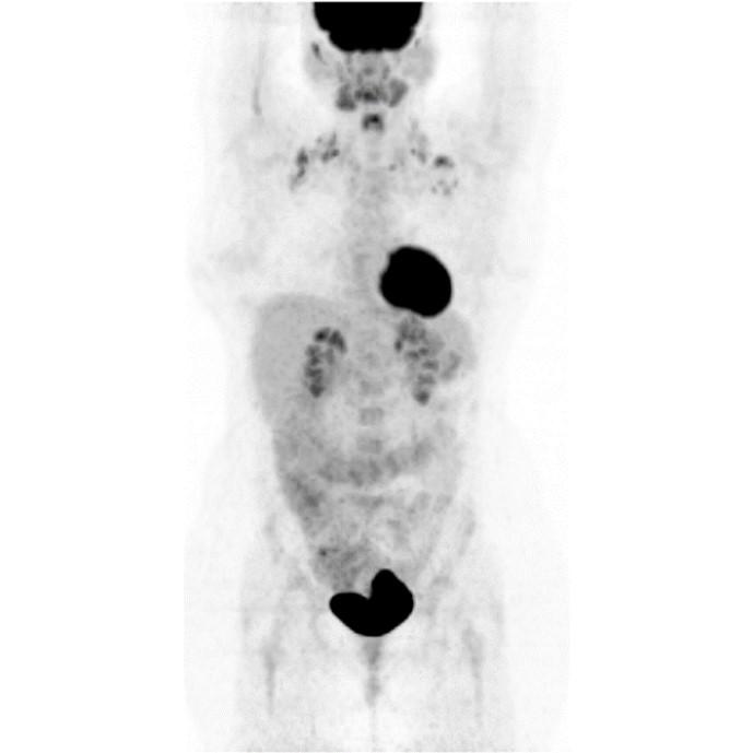 Oncology Indications Cervical
