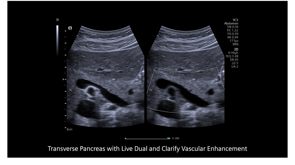 ACUSON Redwood Ultrasound System Siemens Healthineers USA