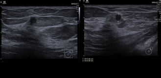 Image B: Ultrasound image shows a 0.5 cm round hypoechoic mass with microlobulated margins in the upper outer left breast.