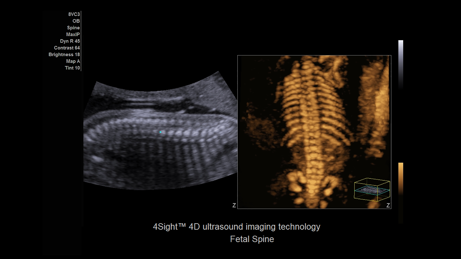 ACUSON Juniper Ultrasound System Siemens Healthineers Phillipines