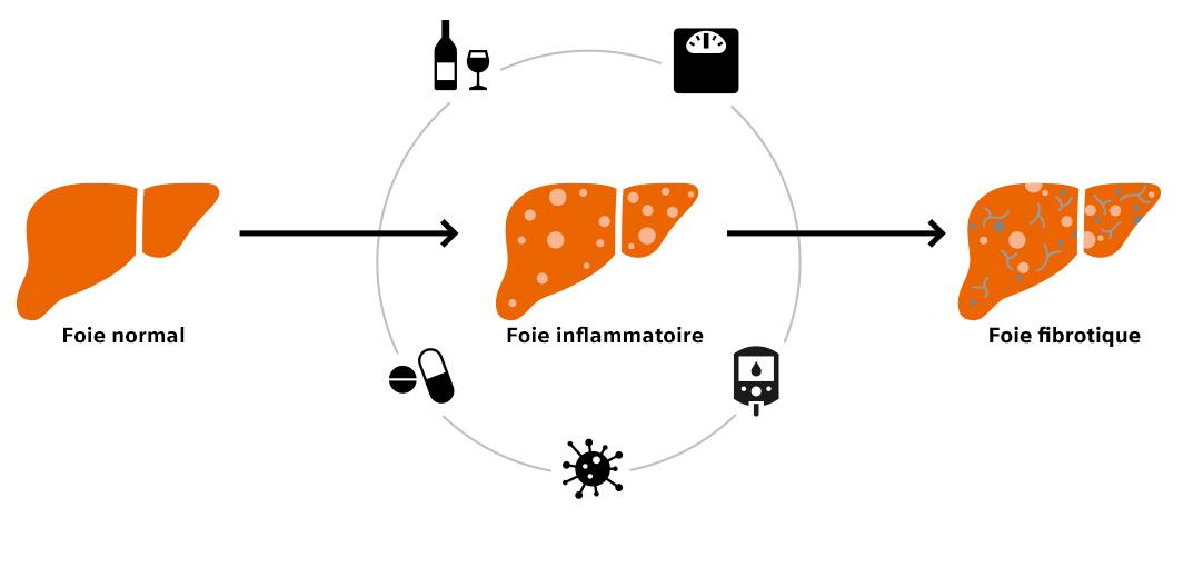 infographic showing the causes of liver disease including excessive alcohol consumption, obesity, diabetes, hepatitis infections, and excessive consumption of medication