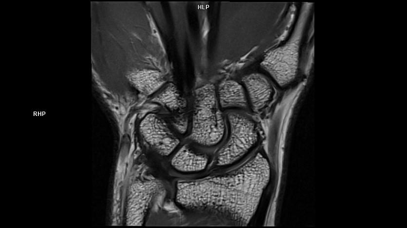 Coronal PD DR Sharp-MAGNETOM Lumina/Coil-Special Purpose/Resolution-448/Scan Time-2:22