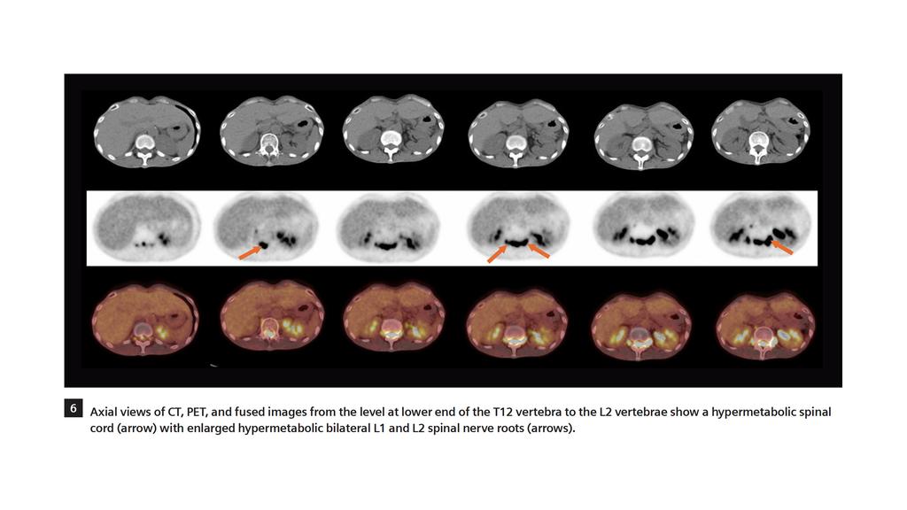 18F FDG PET/CT delineation of diffuse large B-cell lymphoma involving ...