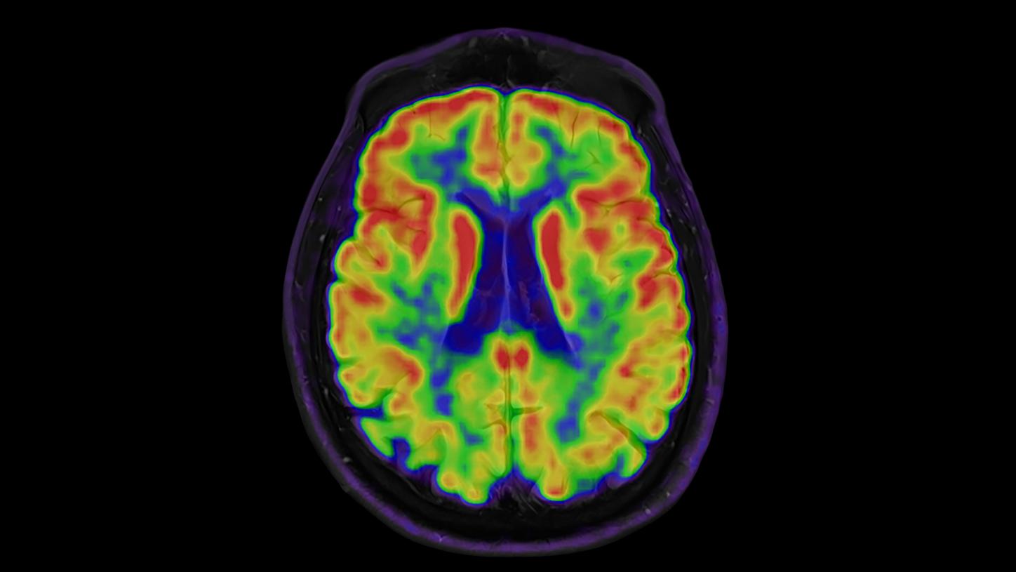 Clinical focus field Alzheimer