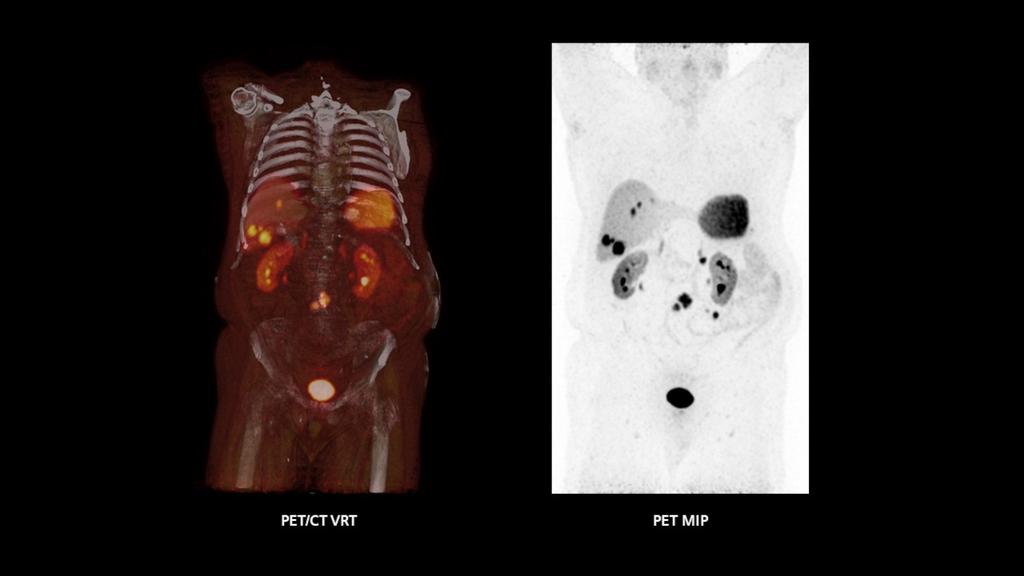 Biograph Trinion PET/CT scanner - Siemens Healthineers