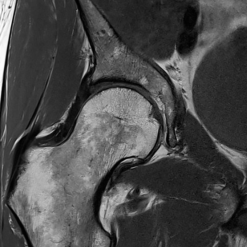 Siemens Healthineers Biomatrix MRI Hip imaging