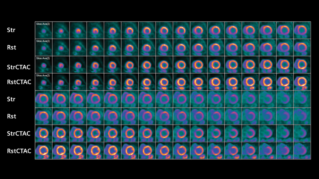 Biograph Vision clinical case