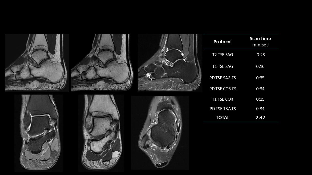 siemens-healthineers_magnetomworld_Foot_Ankle-rountine