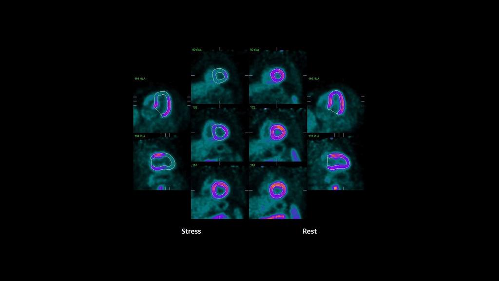 PET/CT delineation of multivessel coronary artery disease and post ...