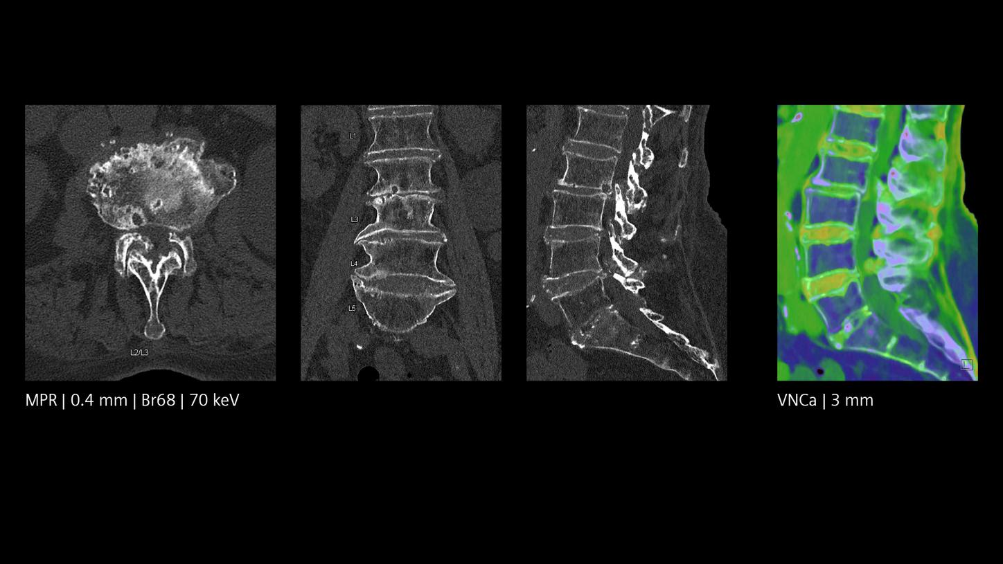 L-spine imaging
