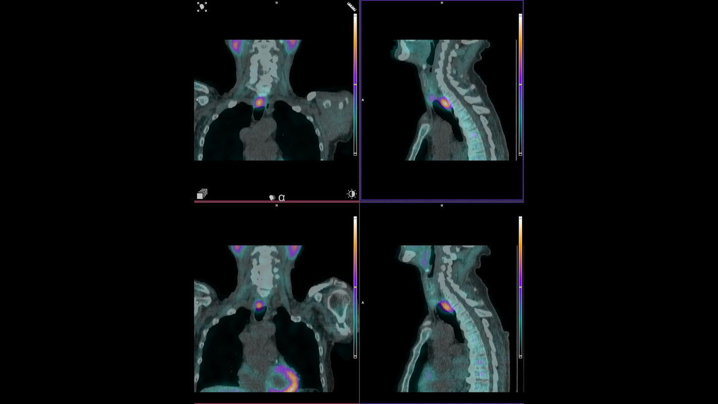 Fused coronal (left) and sagittal (right) SPECT/CT images delineating focal increased uptake of 99mTc MIBI in retropharyngeal parathyroid adenoma.