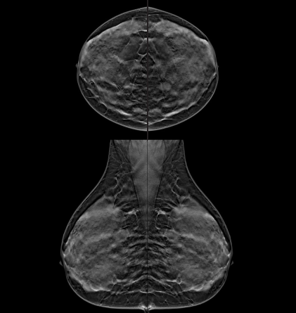 Mammo Findings