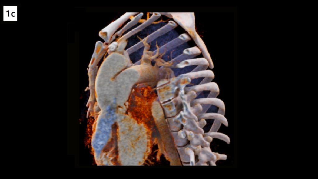 Unrepaired persistent truncus arteriosus in an adult - Siemens Healthineers