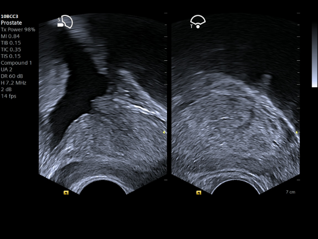 Prostate ultrasound exam