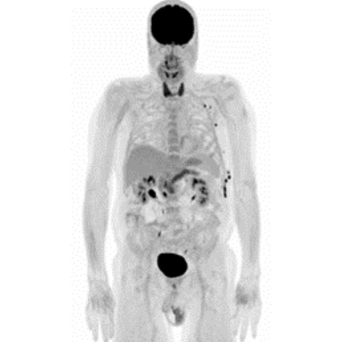 Oncology Indications Thyroid