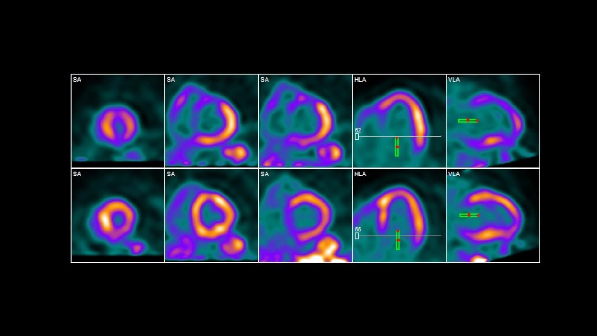 Expanding access to advanced cardiac care: The rise of PET/CT imaging