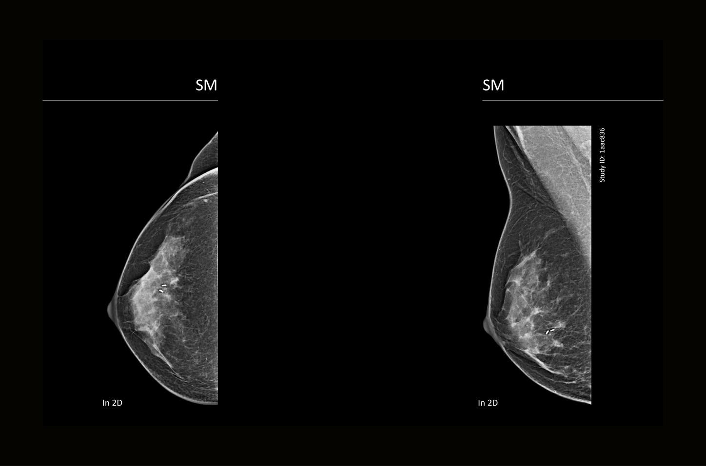 CT image of retro-ocular masses causing exophthalmos along with bilateral perinephric, pericardial, and pelvic exudates