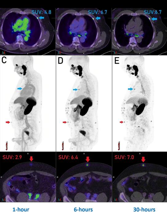 Next-level theranostics with total-body PET/CT