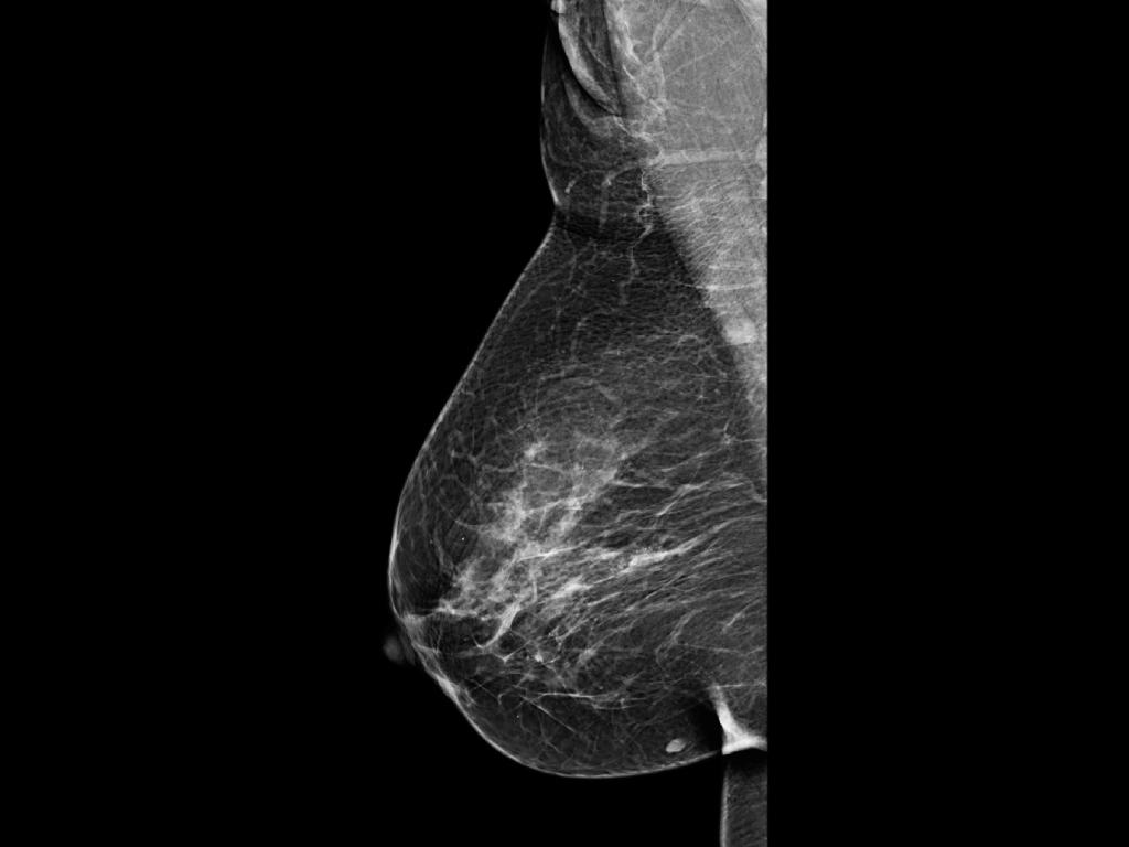 4-3_mamografia-de-rastreio-mloD