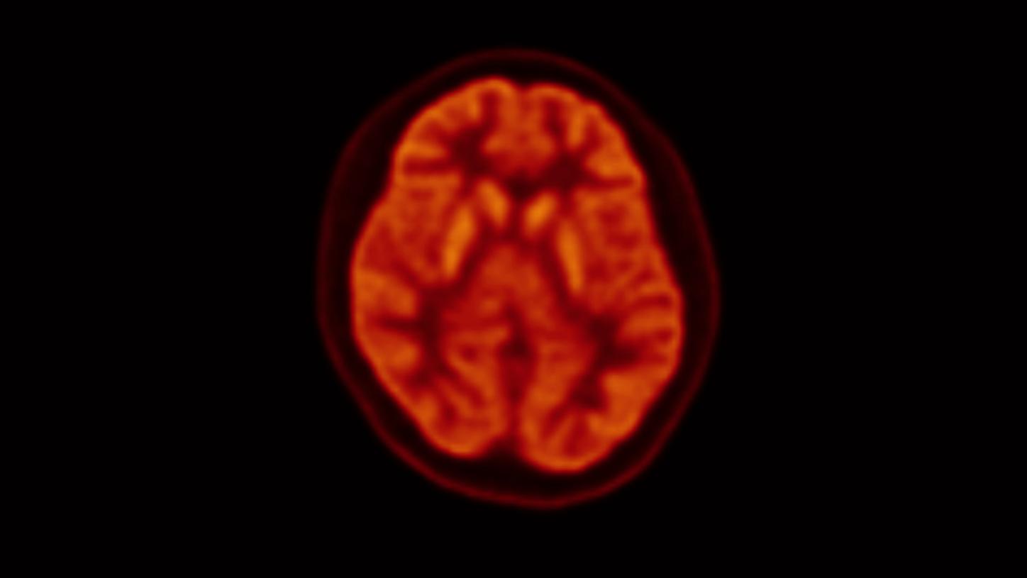 Transverse 18F FDG brain image