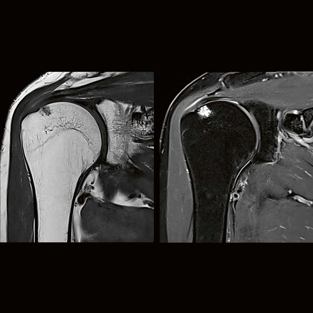 Shoulder imaging  with the new Shoulder Shape 16