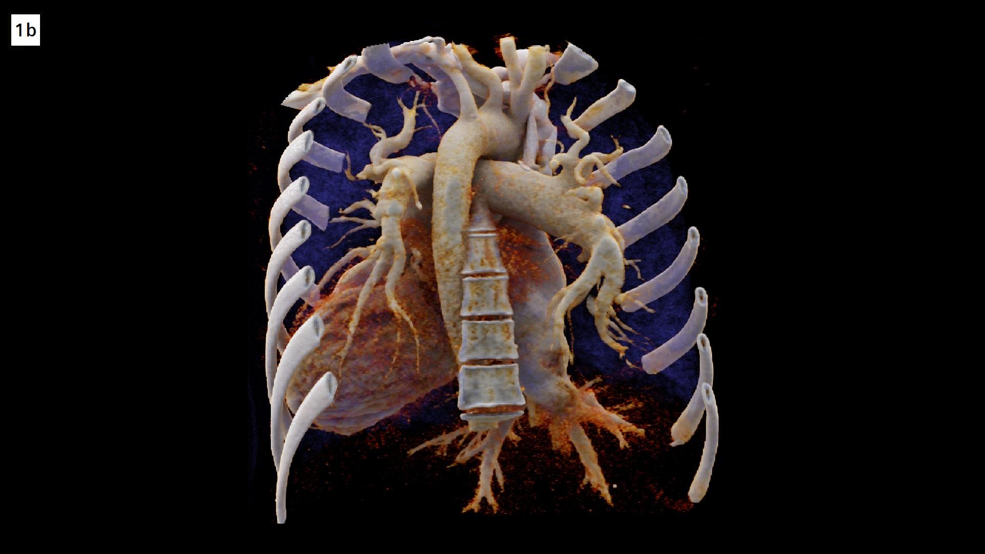 Unrepaired persistent truncus arteriosus in an adult - Siemens Healthineers
