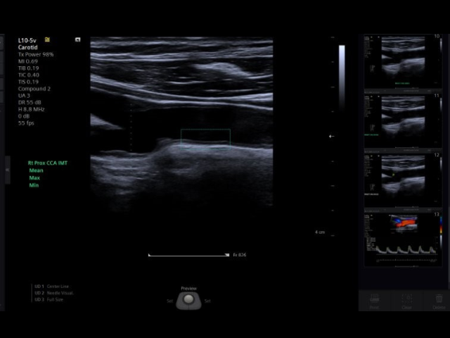Intima-media thickness (IMT) measurement