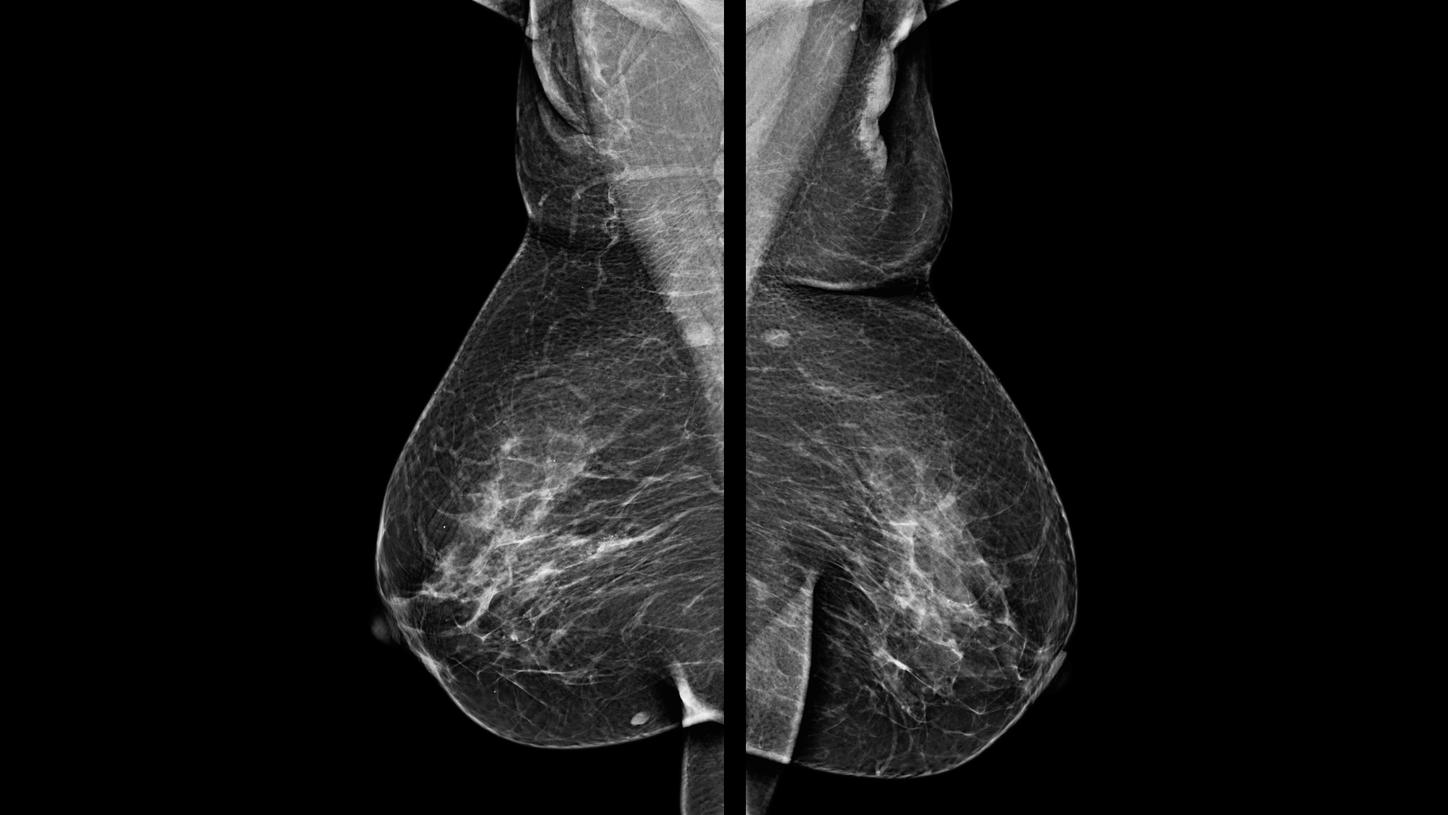 mamografia-bilateral-de-rastreio-1