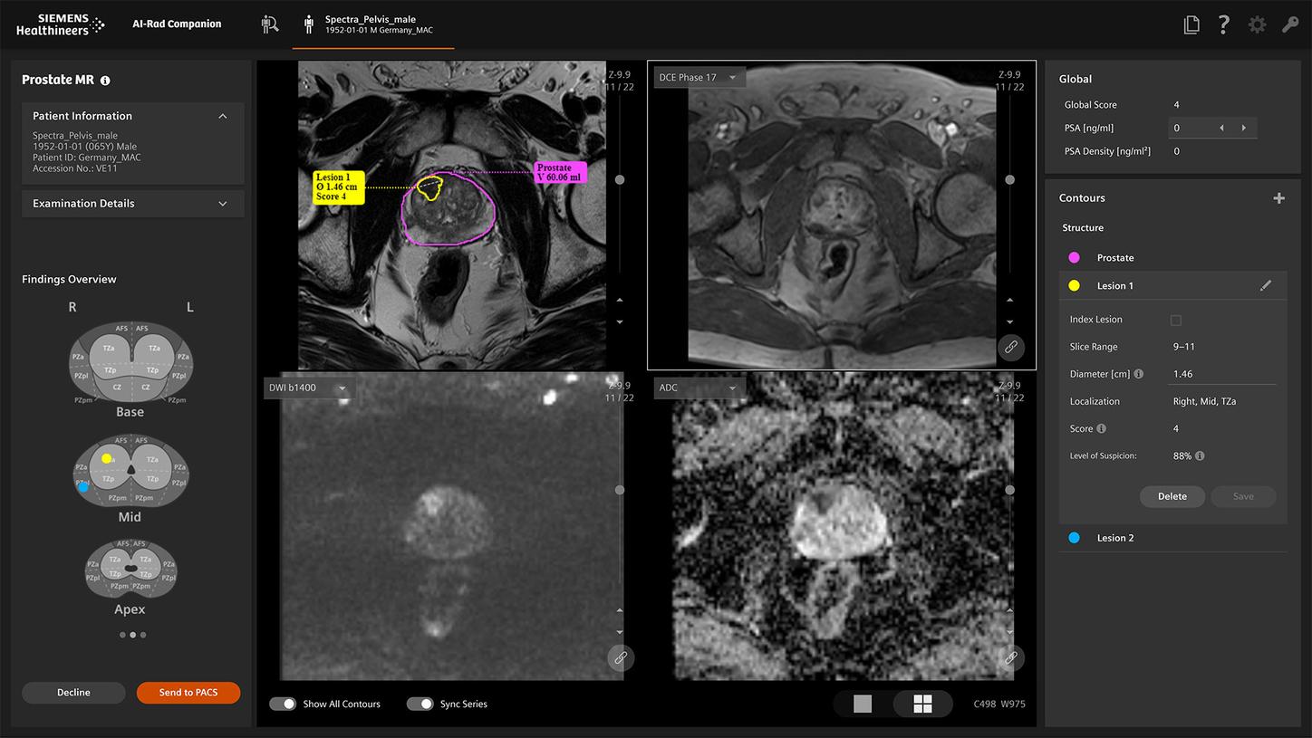AI-Rad Companion Prostate MRI automatically detects and segments suspicious lesions, visualizes their location, and provides a PI-RADS score recommendation.