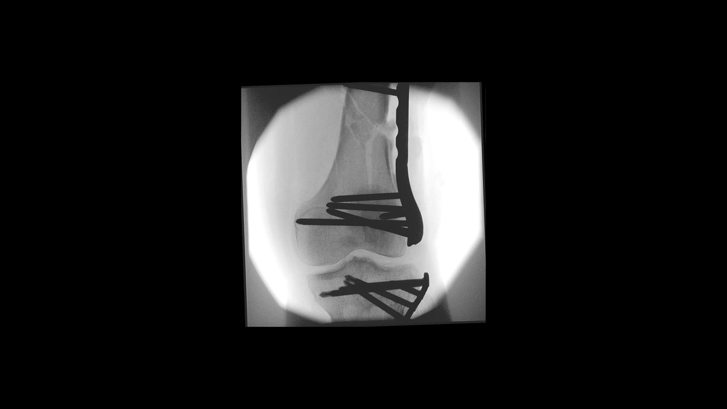 Femur surgery with Cios Select, a 2D C-arm for surgery.