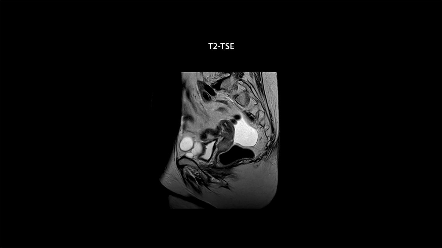 Advanced pelvic MR imaging clearly delineates gynecologic tumors