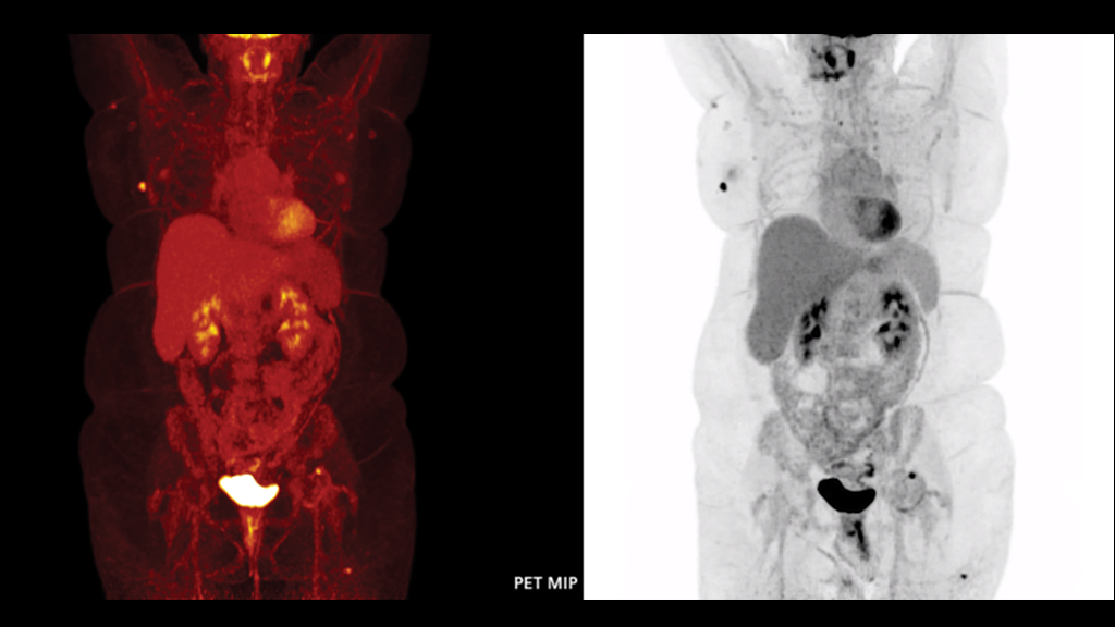 Biograph Vision clinical case