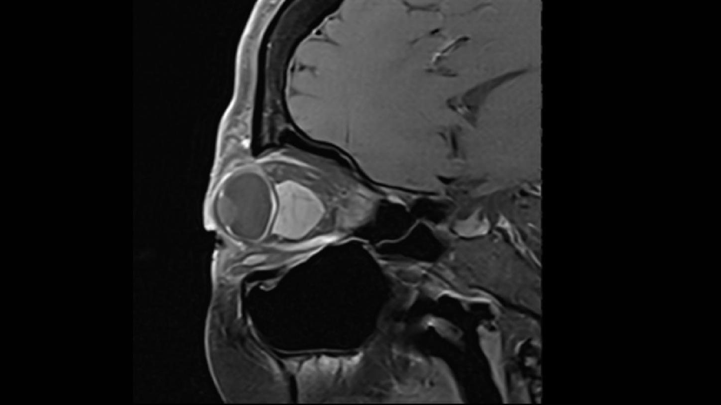meningioma óptico