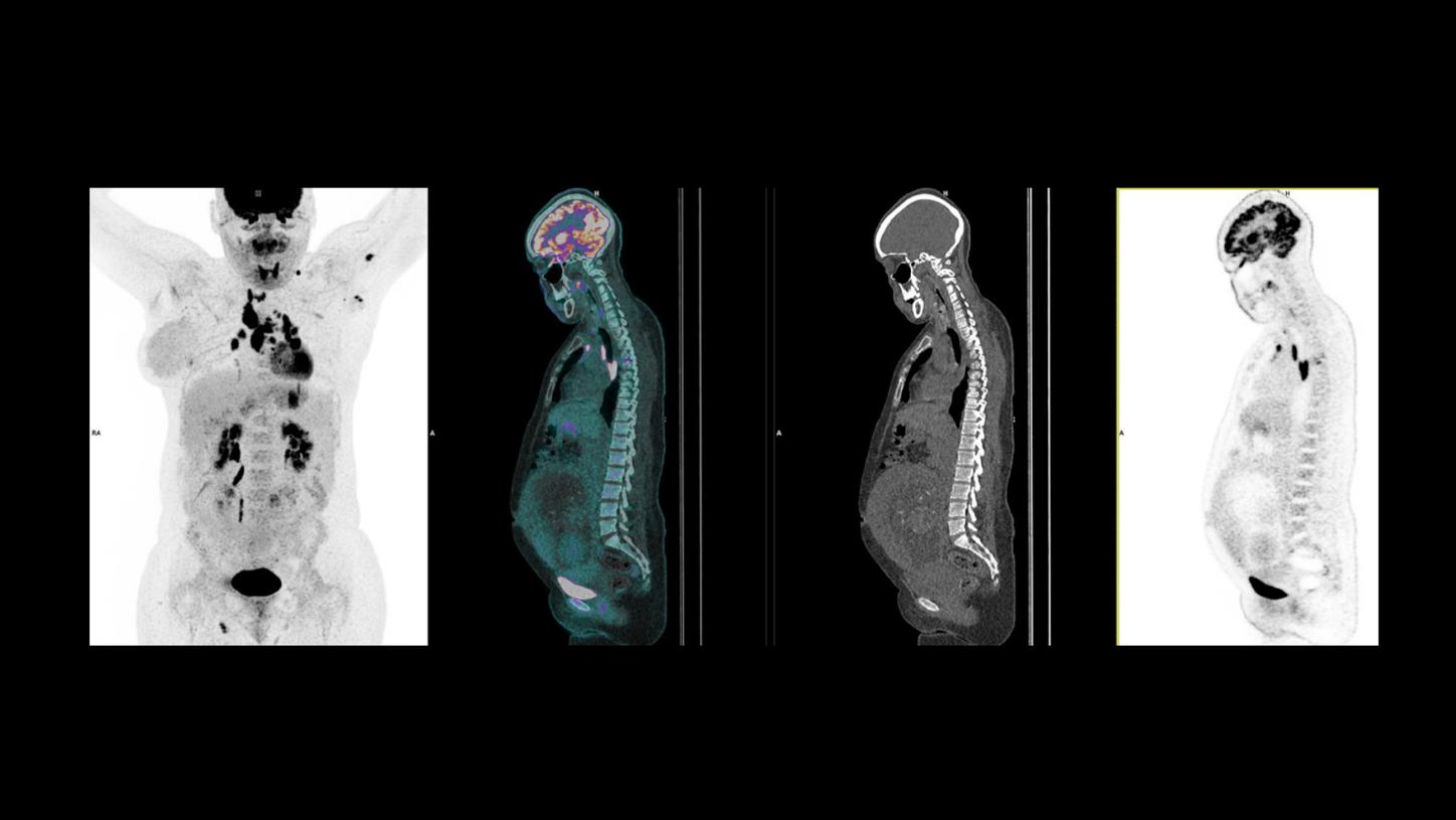 Pregnant (20 weeks); Breast Cancer