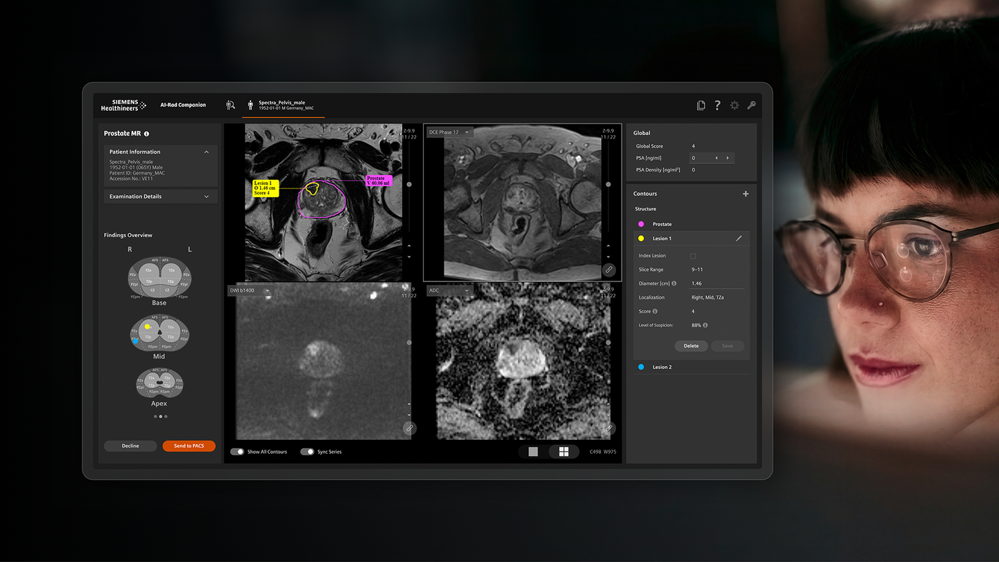 AI-Rad Companion Prostate MR screen with mood person