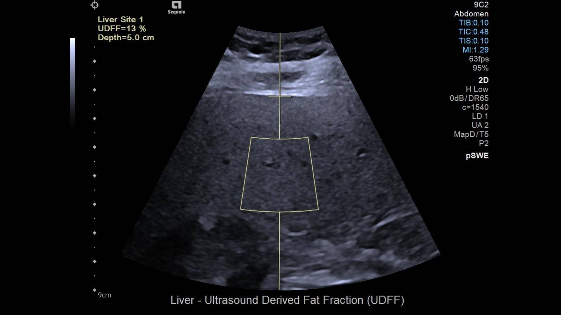 9C2 Transducer with ultrasound derived fat fraction