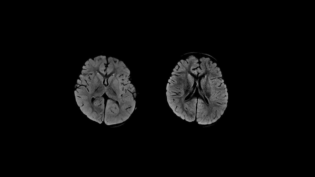 resolve diffusion MRI drakfluid