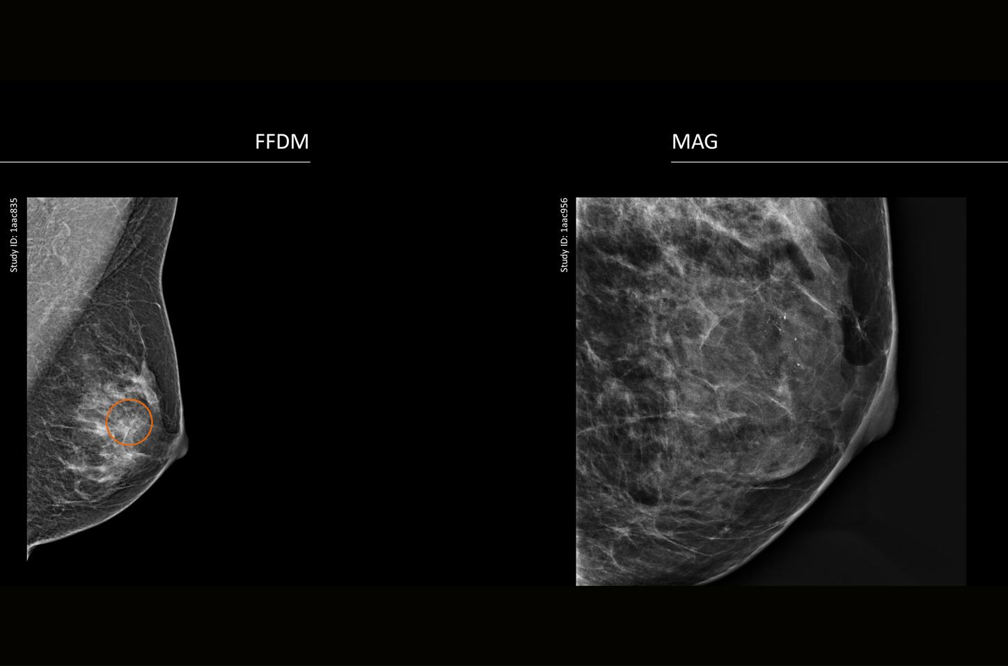 CT image of retro-ocular masses causing exophthalmos along with bilateral perinephric, pericardial, and pelvic exudates