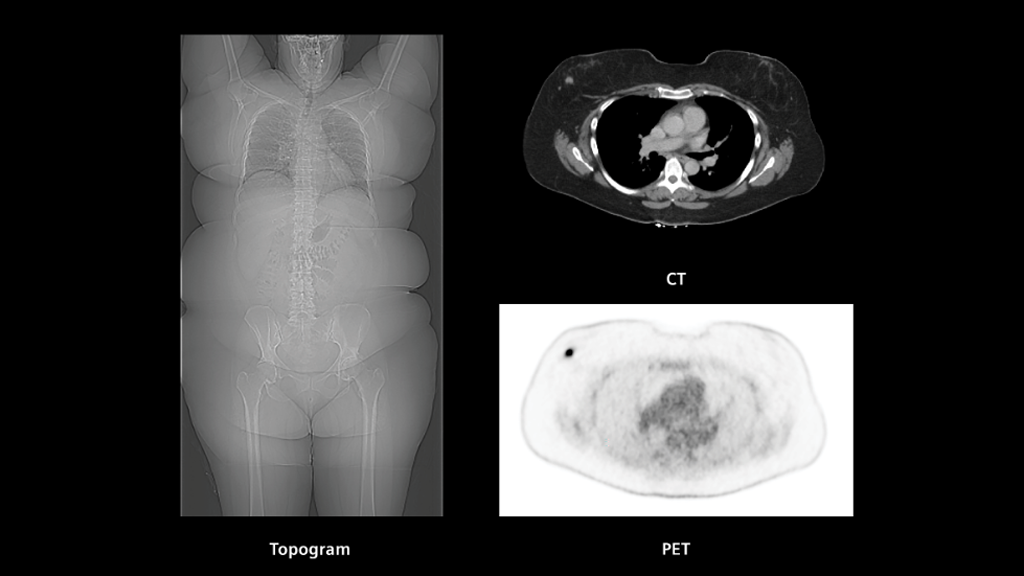 Biograph Vision clinical case