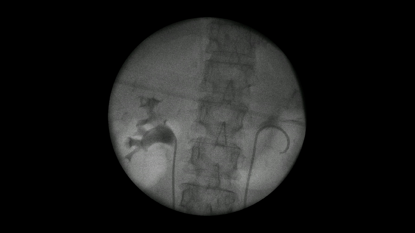Bilateral DJ catheter with Cios Fit, a mobile 2D C-arm for surgery.