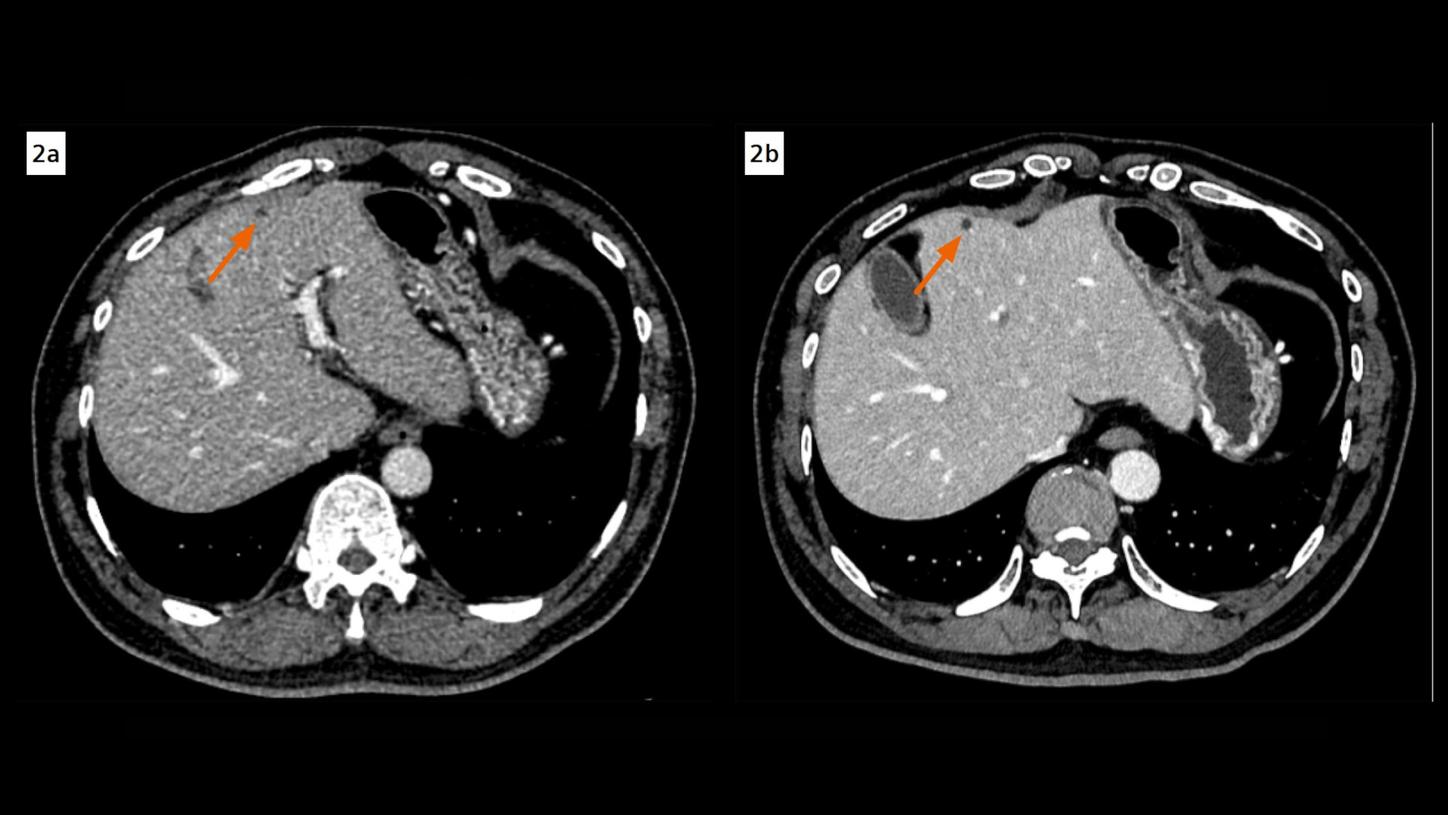 Axial EID and PCD CT images of the liver. A hypoattenuating lesion in the hepatic segment IV, exhibiting indistinct margins and equivocal enhancement in an EID CT image, is clearly characterized as a non-enhancing, sharply delineated cyst in a PCD CT image. Both images are reconstructed at 1 mm, displayed at same window settings. The image noise is notably less in the PCD CT image.