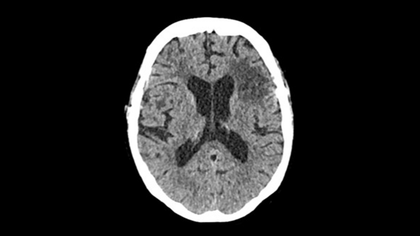 SOMATOM Pro.Pulse in neurology