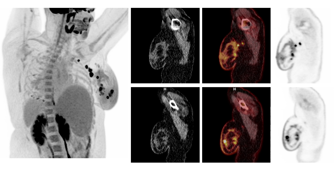 PET/CT in pregnant patients