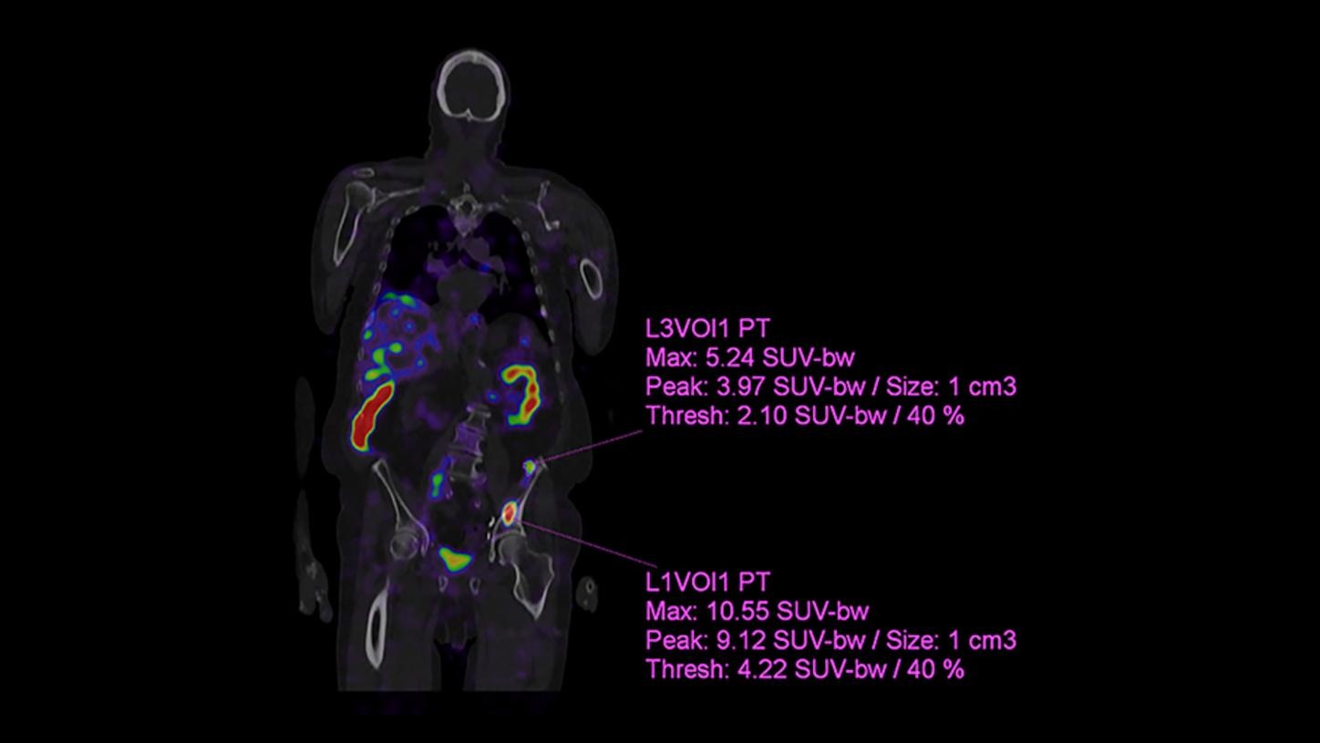 Fast SPECT/CT with xSPECT Quant - quantitative assessment post treatment - clinical image- Fast Lu