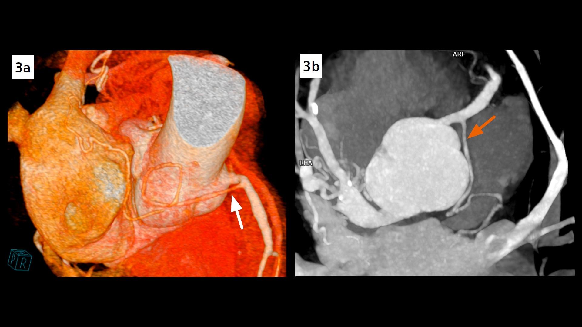 Complex coronary artery fistulas and aneurysm in an asymptomatic