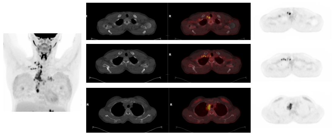 PET/CT in pregnant patients