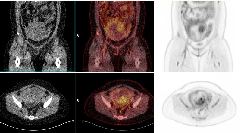 PET/CT in pregnant patients