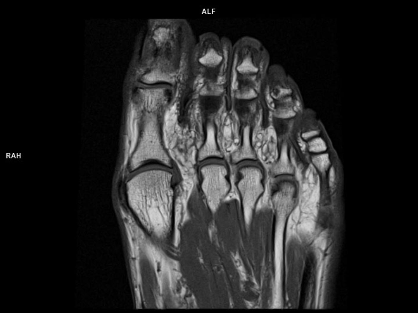 Coronal T1 TSE/MAGNETOM Lumina<br />