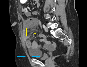 Fig. 11: Yellow arrow showed focal segment of small bowel devoted from iodine /contrast uptake, blue arrow showed normal mucosal enhancement.