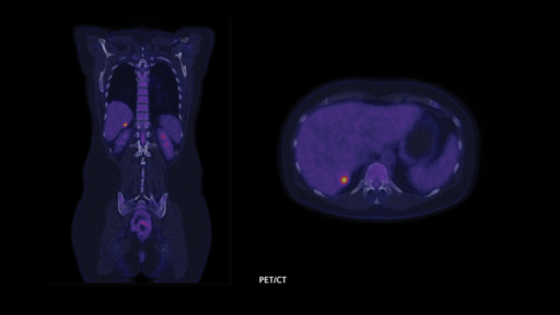 Biograph Vision PET/CT Clinical Image Gallery - Siemens Healthineers